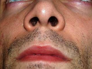 Rady, jak se zbavit suché sliznice nosu
