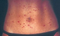 Cerkariální dermatitida